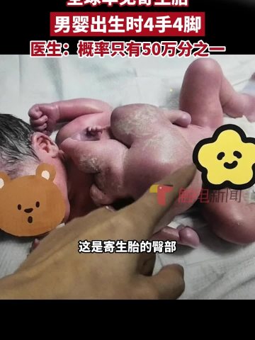 全球罕見寄生胎!深圳一男嬰出生時4手4腳,醫生:概率只有50萬分之一