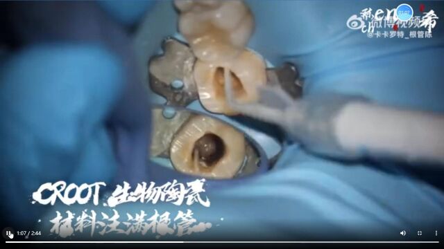 陈希老师CRoot SP C型根管充填