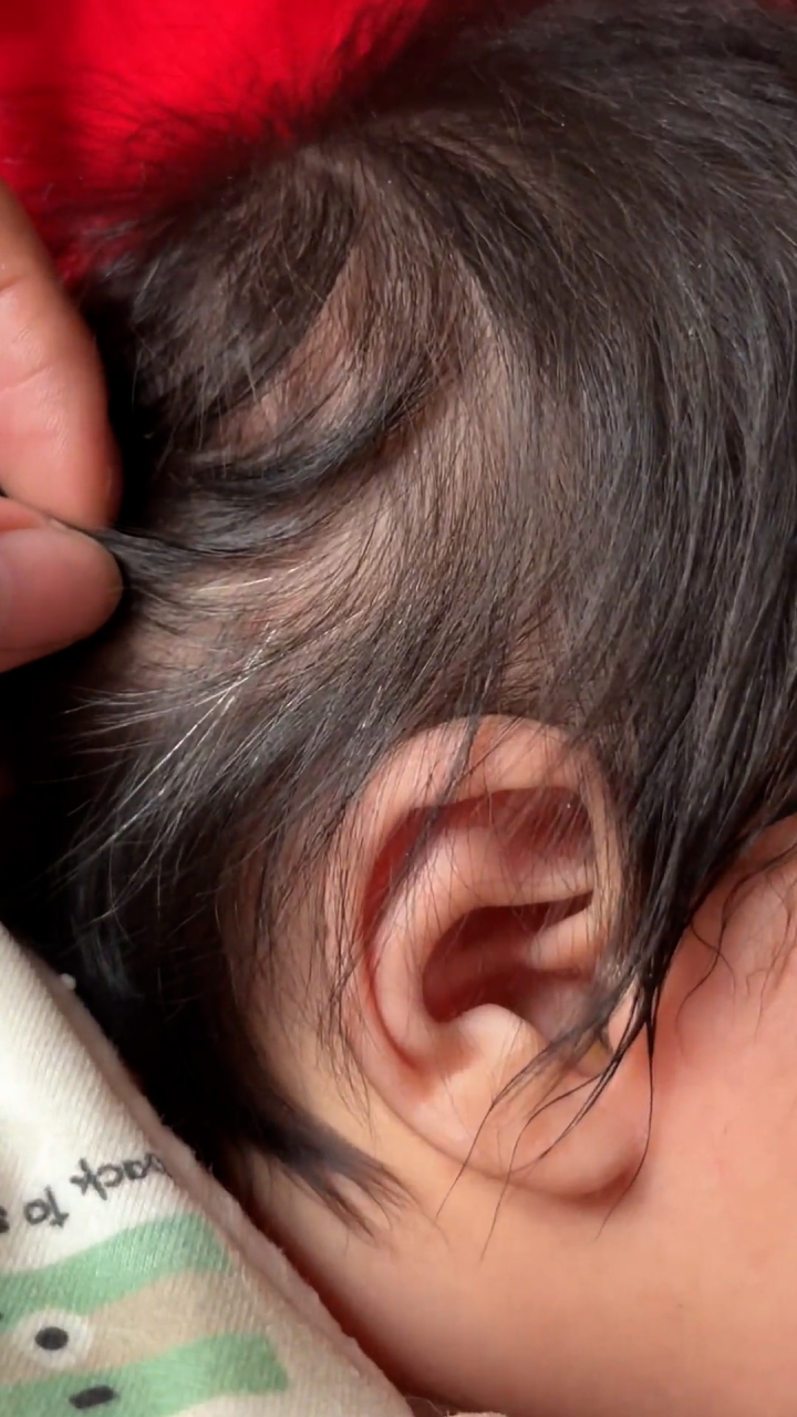 3个月女宝宝天生长一撮白发,母亲:体检一切正常