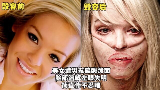 美女遭男友硫酸泼面,脸部几乎溶解,经历32次整容,如今怎么样?