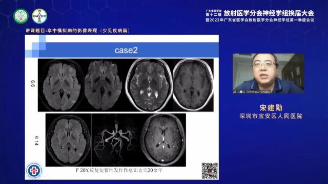 卒中模拟病影像表现(少见疾病篇)深圳市宝安人民医院宋建勋