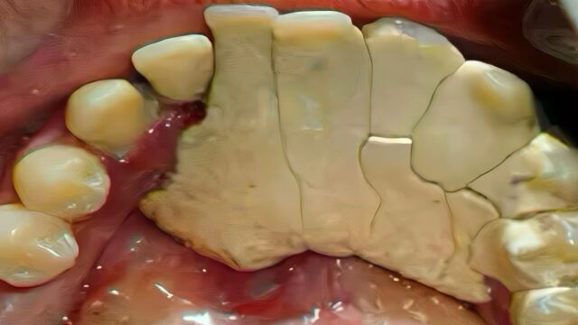 堆积如山的牙结石如何清除?掌握两个小妙招,顽固牙石一刷就掉!