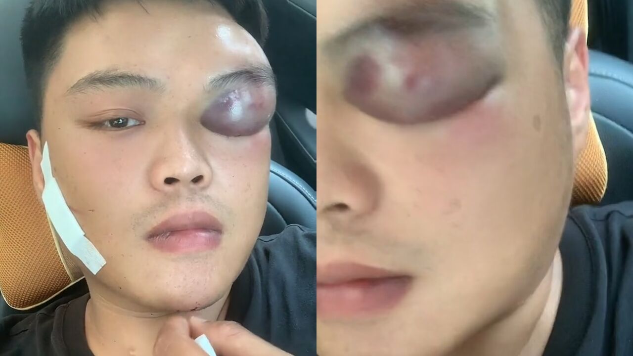 男子骑三轮车意外撞墙上,眼睛淤血肿成"悲伤蛙":变身失败了?