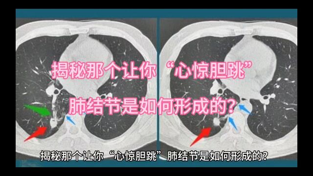 揭秘那个让你“心惊胆跳”肺结节是如何形成的?