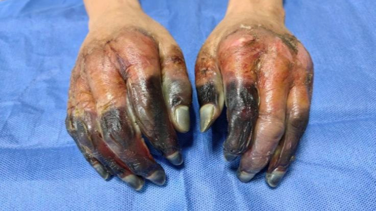 南方小土豆勇闯冰雪世界冻伤医生严重的要截肢