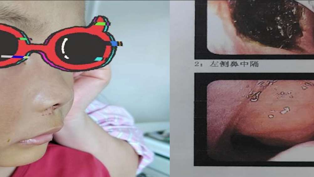 看好小孩!男童面部肿胀流鼻血发烧,竟因鼻腔内塞了纽扣电池