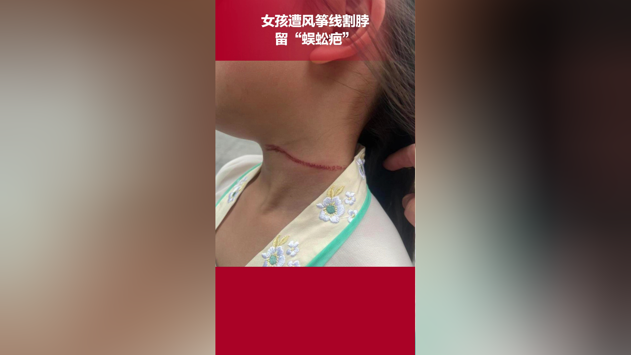 女孩遭风筝线割脖留"蜈蚣疤",母亲:线拉拽后就像无形的刀,真的很危险