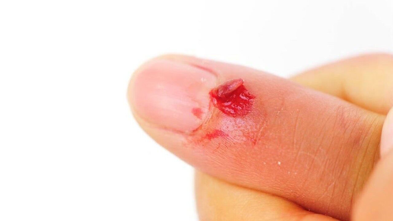 手上起了倒刺怎么办老外教我一招不用手撕倒刺自己跑出来