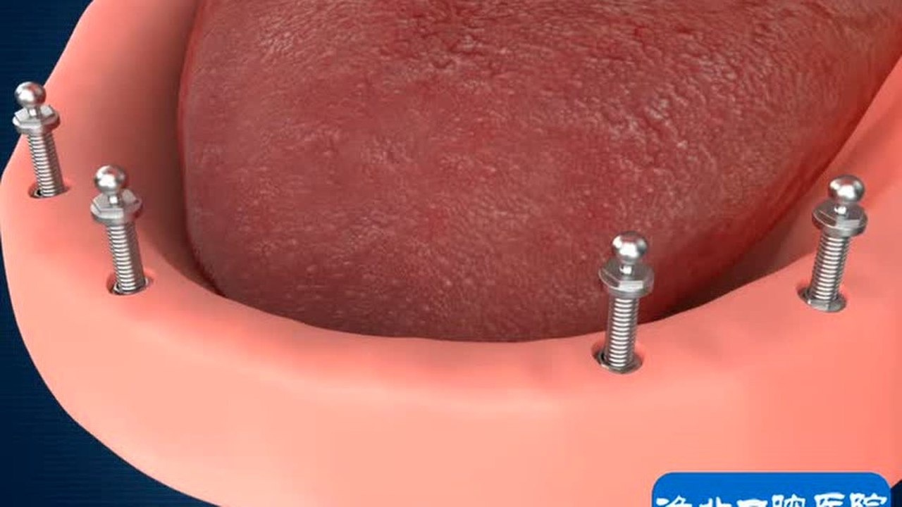 下颌球帽-4颗种植体