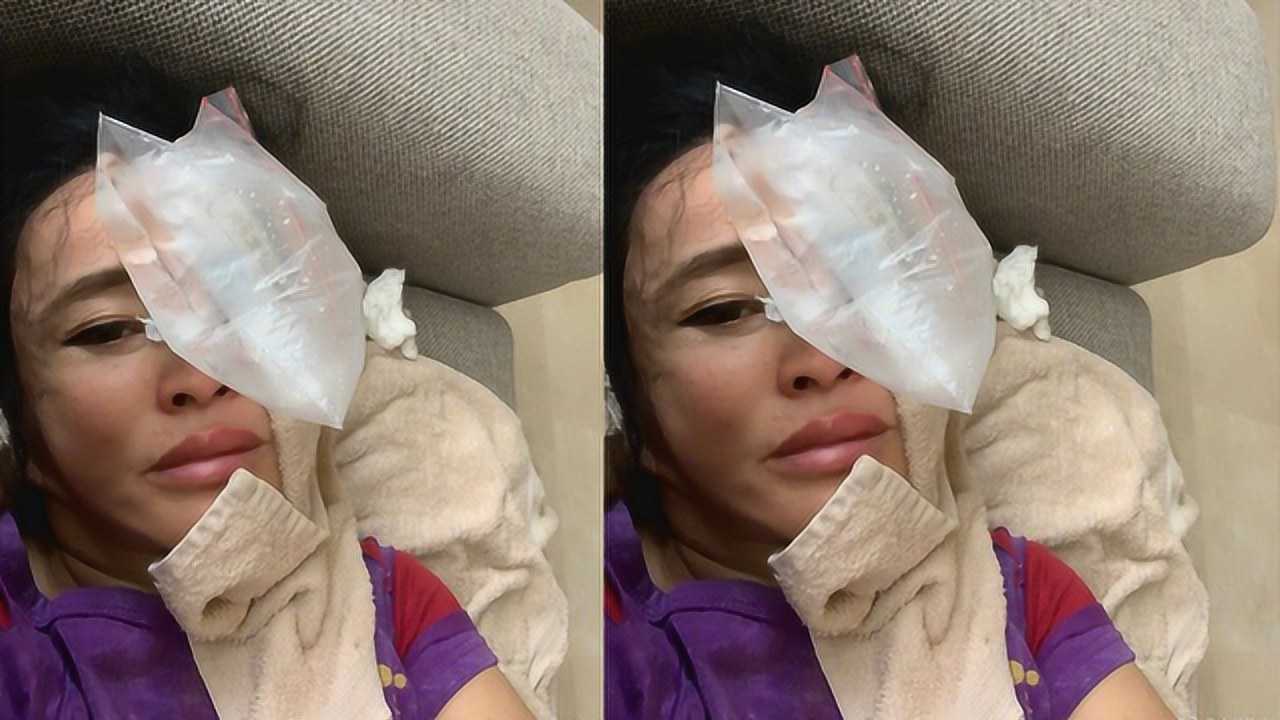 刘晓庆面部意外受伤 晒冰敷素颜照暗示自己未整容