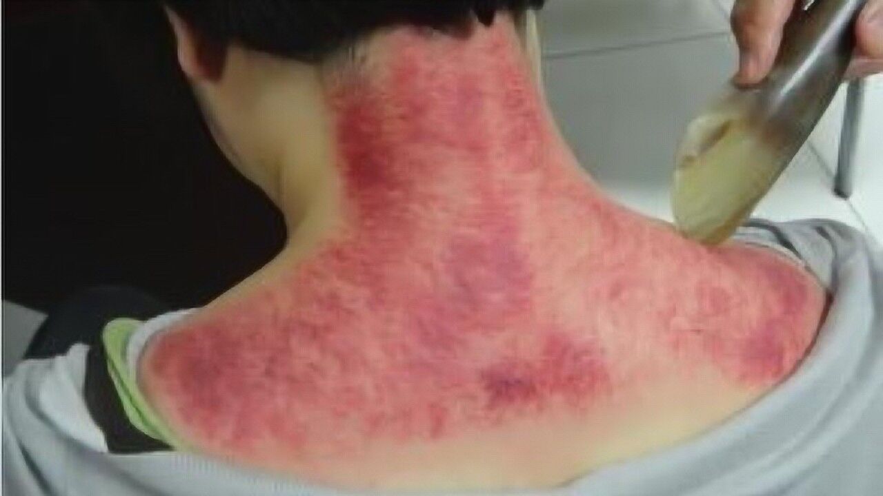 斑点痧,斑点痧图片_大山谷图库