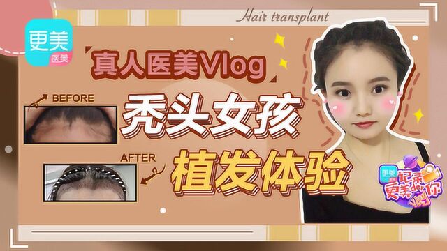 真人医美vlog—秃头女孩植发体验