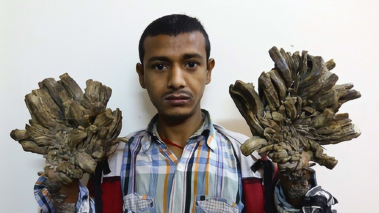 印尼树人遗憾去世到死也没能治好怪病