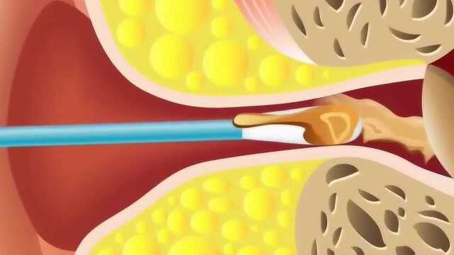 用棉签掏耳朵有多危险?3D动画演示给你看!