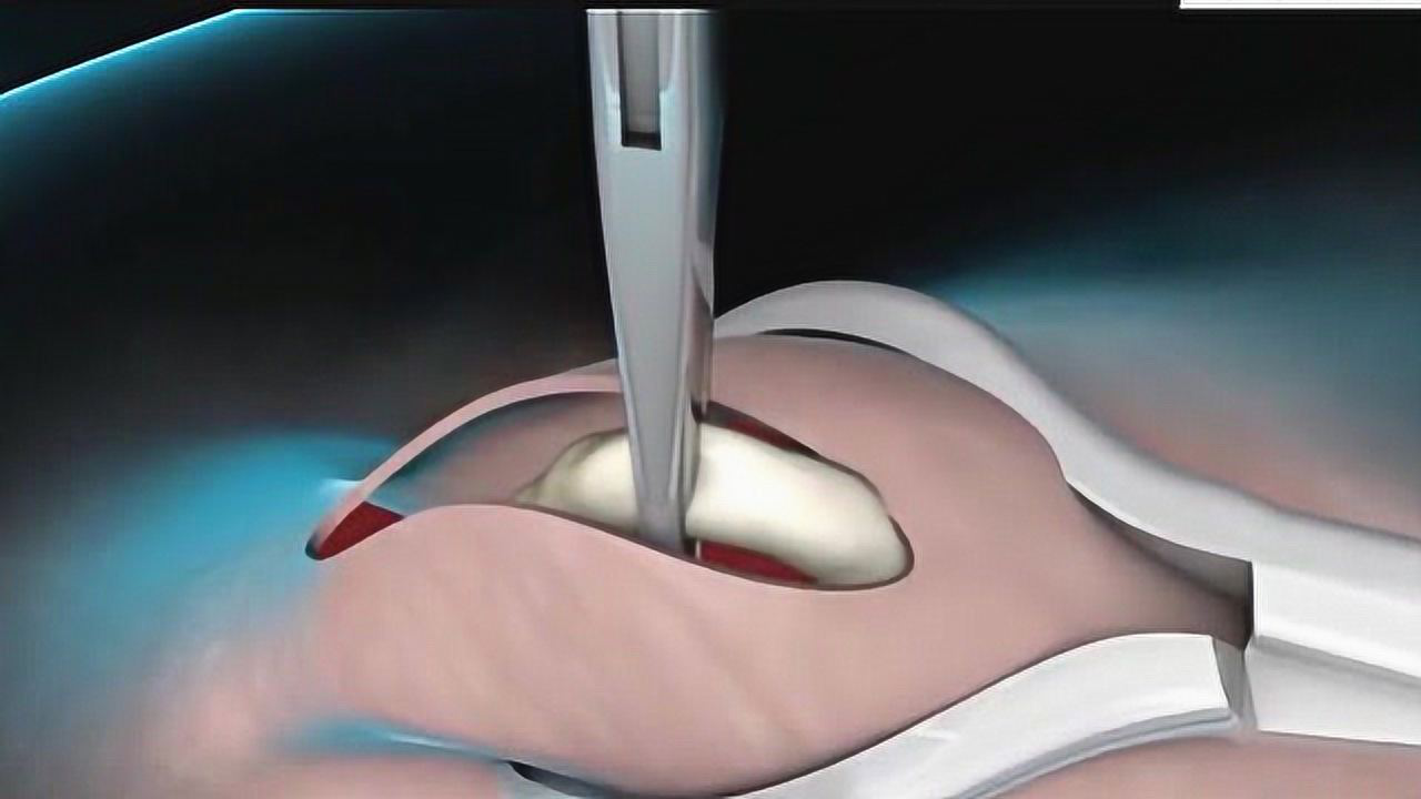 男性结扎到底有多疼3d动画模拟全过程看完别不当回事