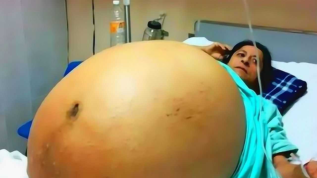 孕妇肚子竟然还能这么大？怀了一个足球队吧！医生：第一次见！_高清