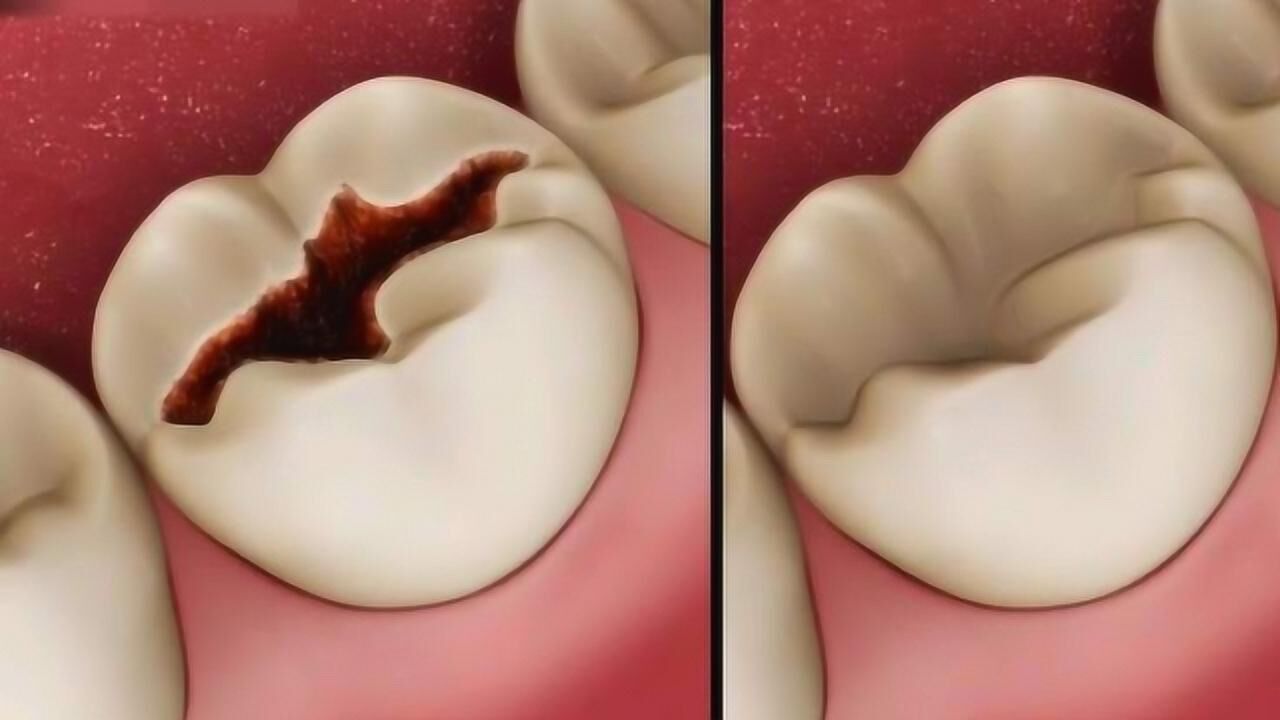 窟牙过程图片
