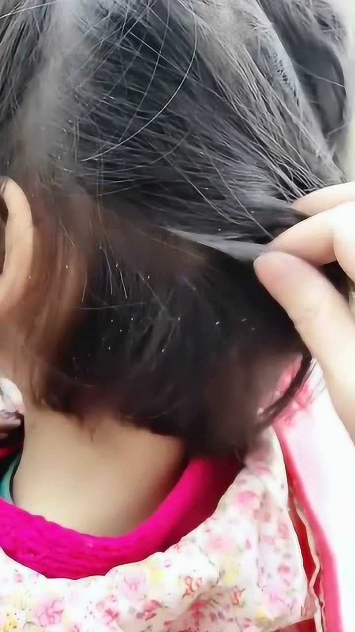 萌娃头上有虱子看到头皮都发麻还有人不爱干净