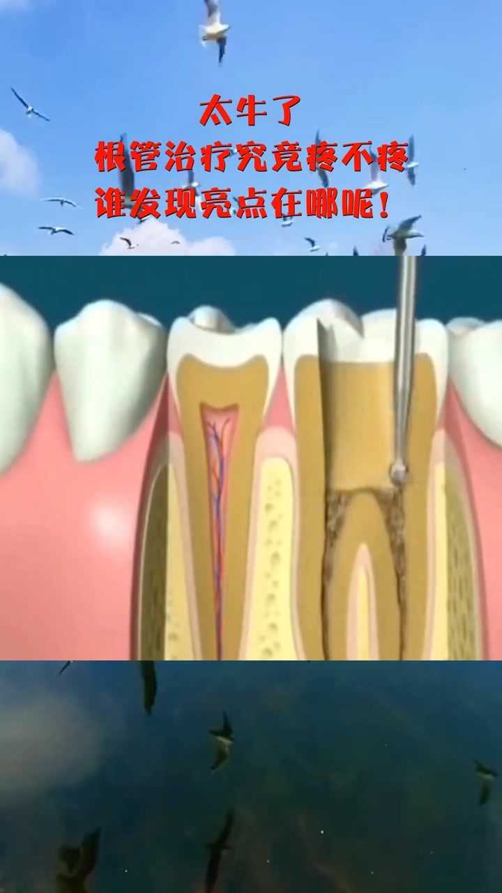 太牛了根管治療究竟疼不疼誰發現亮點在哪呢