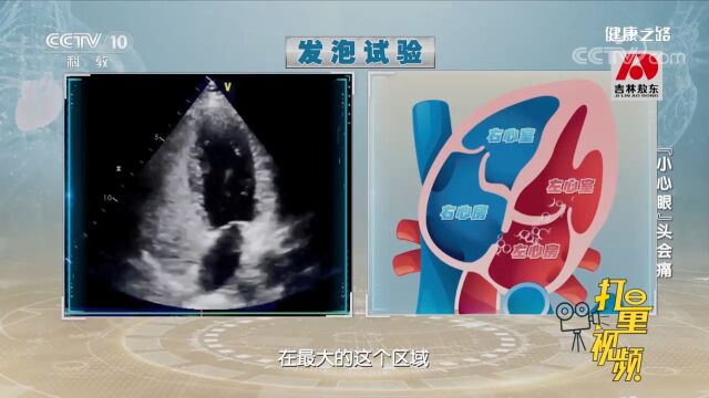 如果出现头痛、耳鸣等,可通过进行发泡实验来诊断卵圆孔未闭病情