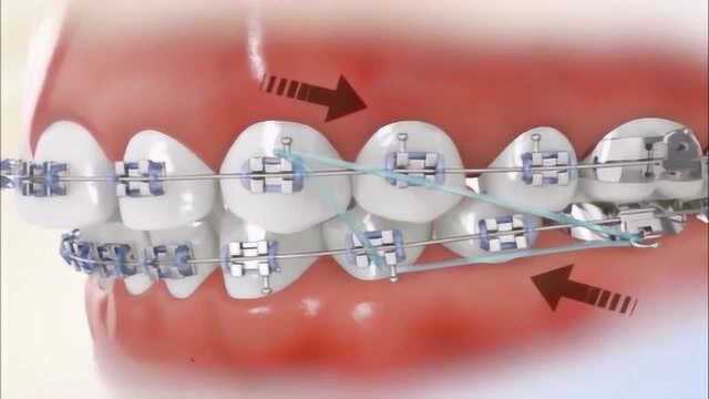 牙齿拥挤拔牙矫正,拔掉一颗虎牙然后矫正,这个方法看着好舒服!