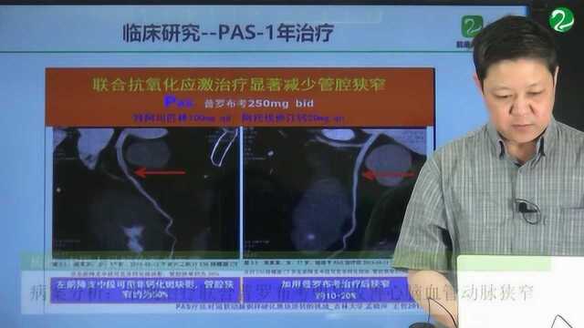 病案分析:常规治疗联合普罗布考明显改善心脑血管动脉狭窄