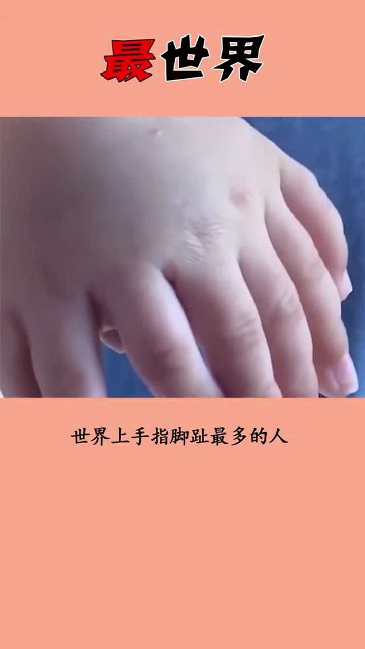 世界上手指脚趾最多的人,是来自中国的一个6岁的小男孩
