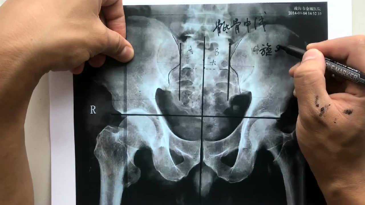 骨盆内旋外旋判断方法