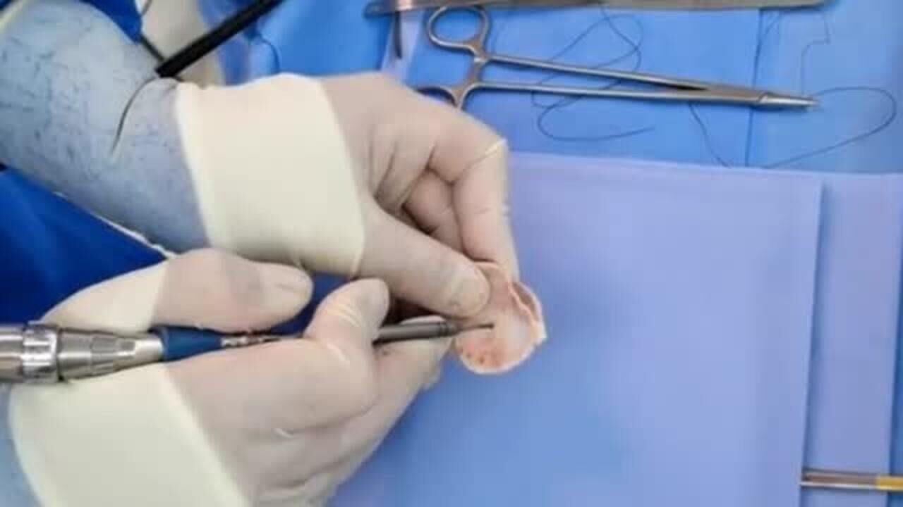 开颅手术用的电钻看到医生用的瞬间站在旁边的我直接愣住了