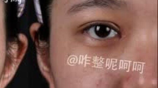 我去割了个双眼皮,顺带开了个眼角,花了一万五!