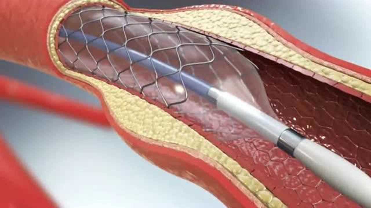 心脏支架是如何放进人体的,看着就特别的神奇,医学技术都这么神奇了吗