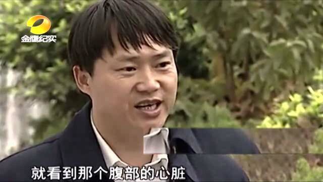 老汉肚子上竟长着一颗跳动的心脏,医生猜测:双心人!