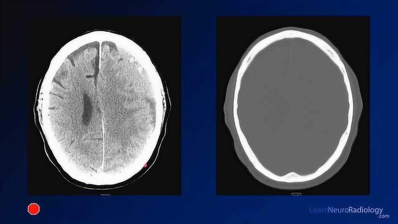 neuroradiology board review 3 case 13a: subdural hematoma
