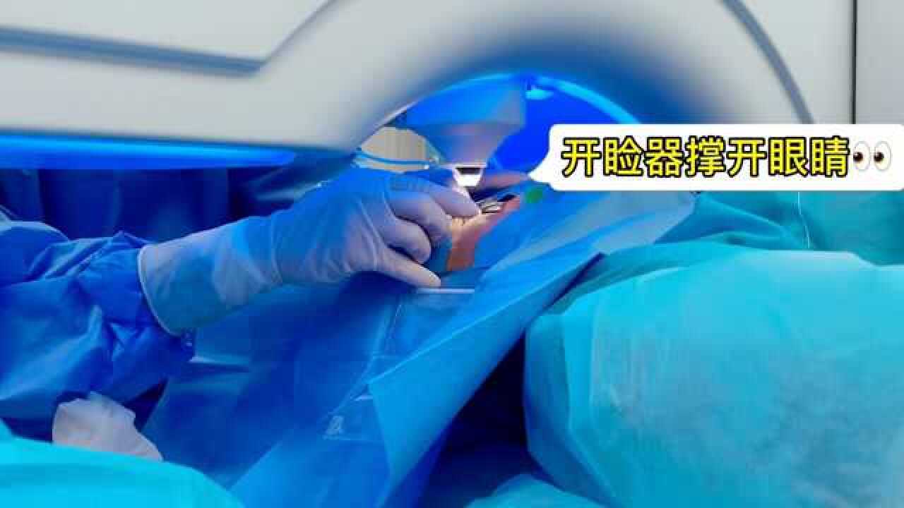 全飞秒近视手术全过程分享给大家