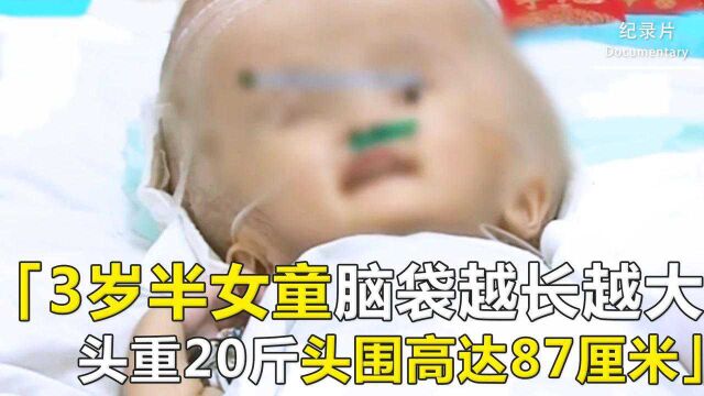 3岁半“大头”娃娃,头围高达2尺6!20斤头颅比成人头部重两倍