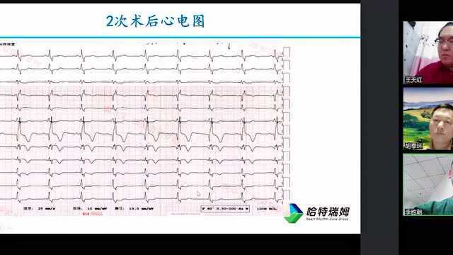 【特别放送】顽梗不化:急诊PCI 术后反复血栓一例|冠脉工坊