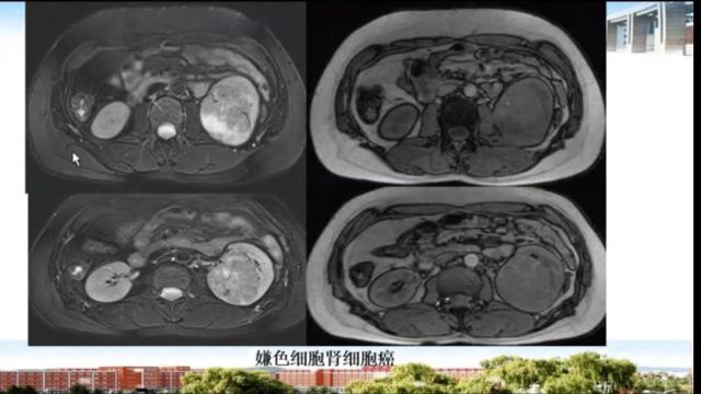 肾癌的分型及影像学表现北华大学附属医院张铎