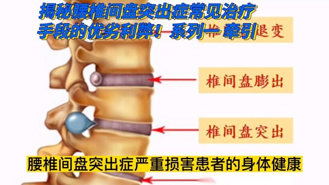 揭秘腰椎间盘突出症常见治疗手段的优劣利弊!系列一 牵引