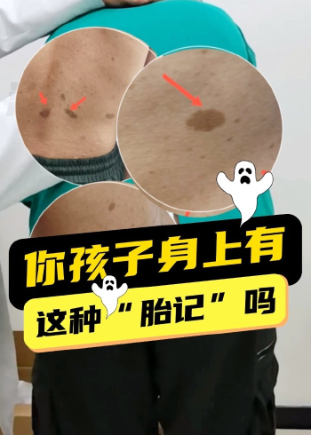 你孩子身上有这种胎记吗?可能是牛奶咖啡斑.