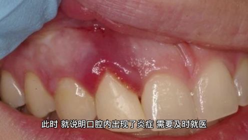牙龈总出血，可能与这4种疾病有关，看看你符合哪一个