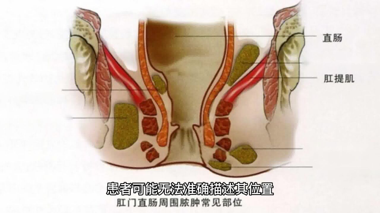 肛门癌是什么症状图片