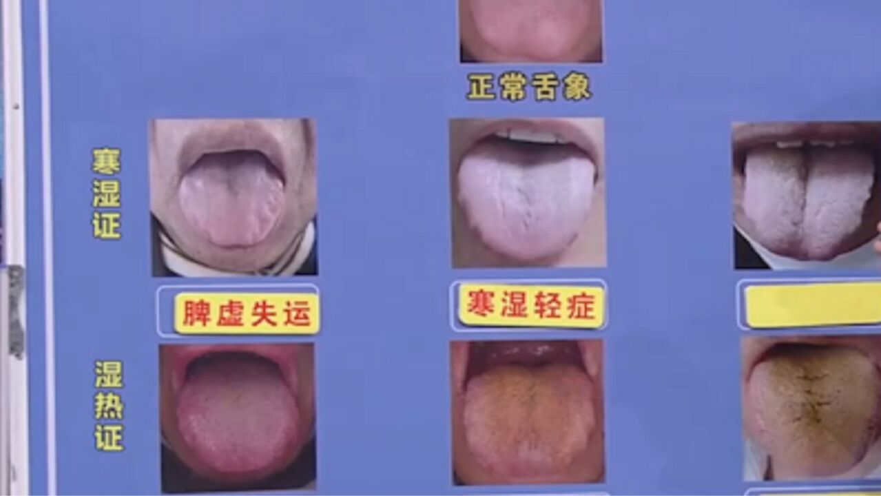 从舌苔就能看出您的体质属于寒湿还是湿热,专家教您判断_高清1080P在线观看平台_腾讯视频