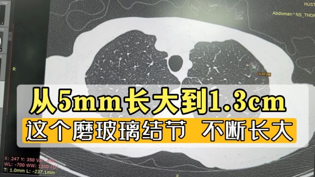 这个磨玻璃结节,在不断长大!从5mm到现在1.3cm