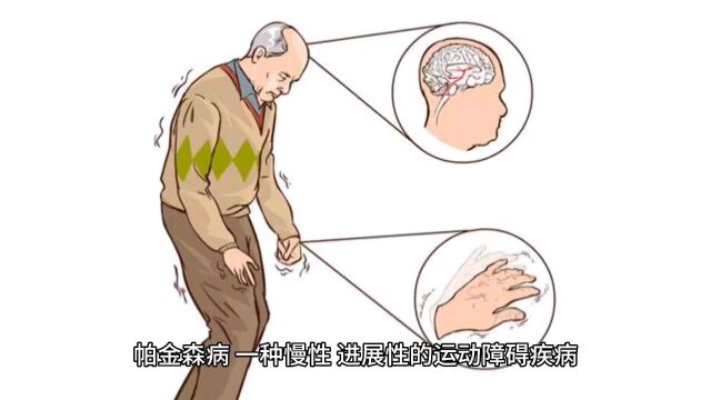 帕金森是一种什么病?