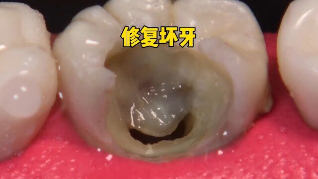 无比酸爽的修复牙齿蛀牙解压视频蛀牙修复