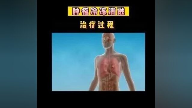 贵州航天医院:氩氦刀冷冻消融治疗肿瘤