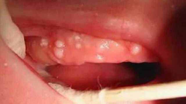 宝宝牙龈上长很多小白点听北京儿童医院牙科主任怎么说