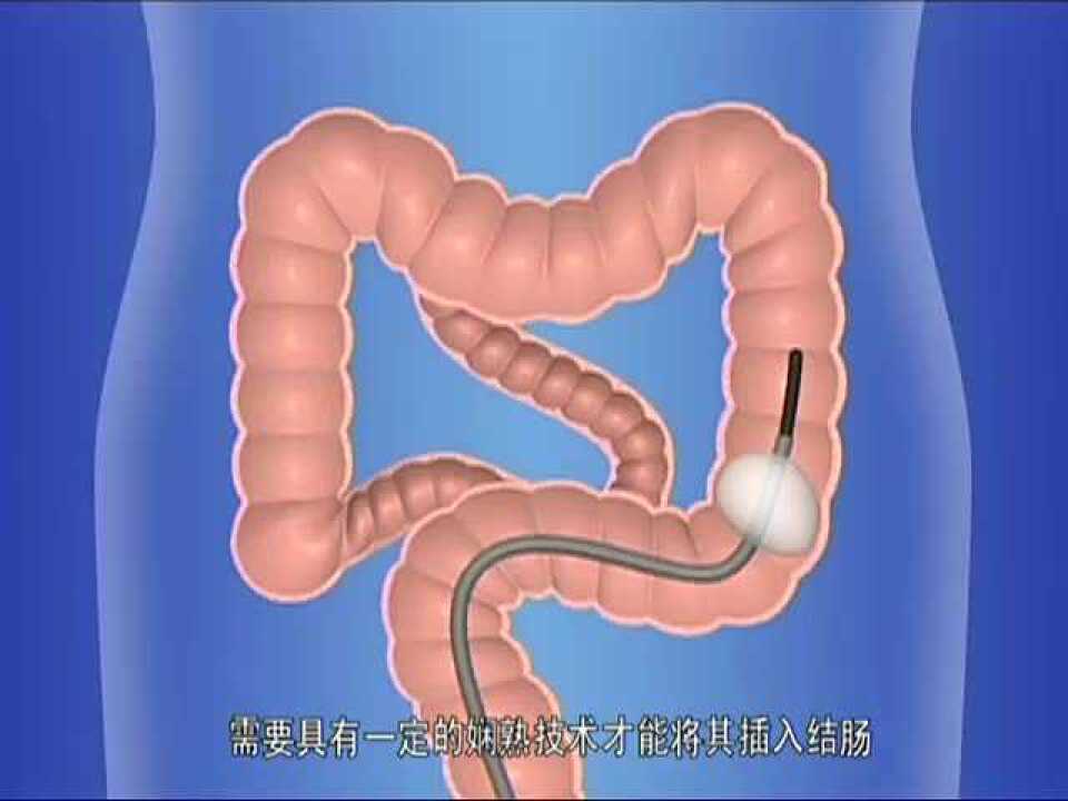 单气囊小肠镜系统插入操作概述_高清