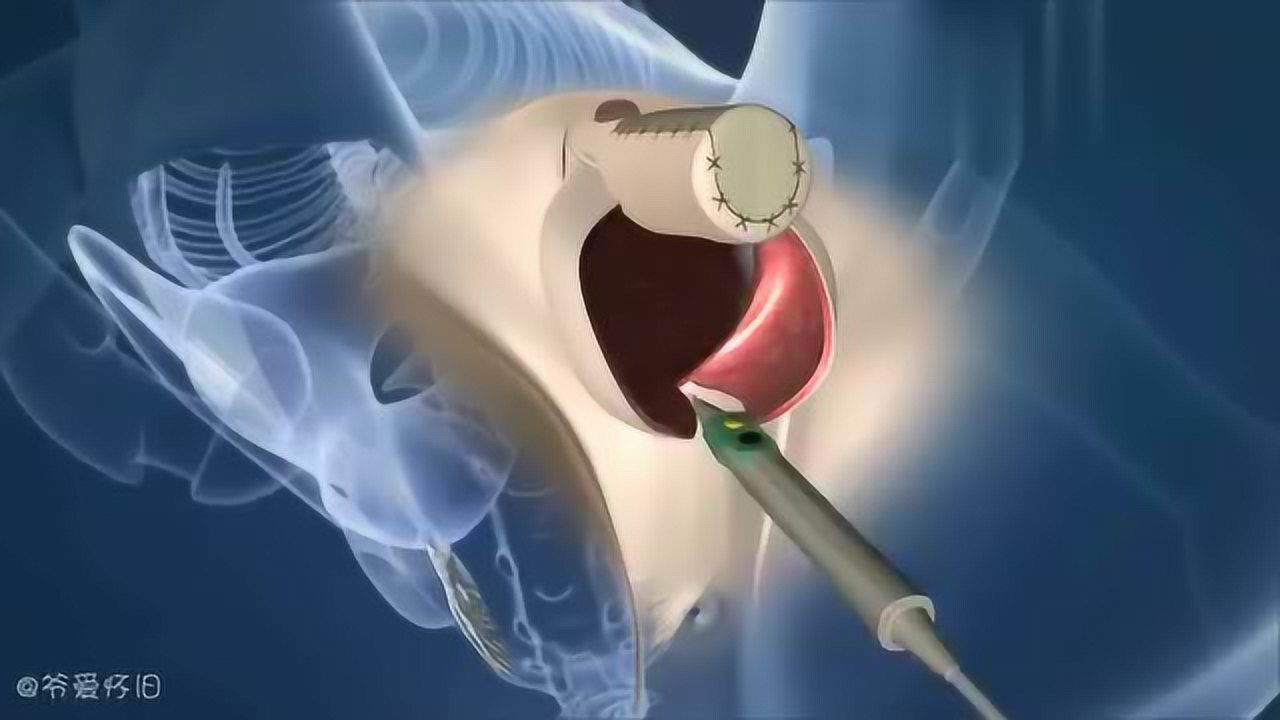 变性手术 演示动画图片
