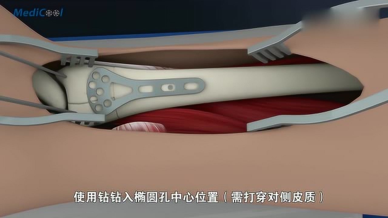 演示手臂桡骨尺骨骨折手术全过程，手术视频_腾讯视频